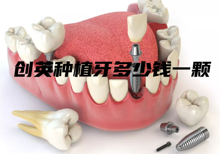 创英种植牙多少钱一颗？www.hszkq.cn
