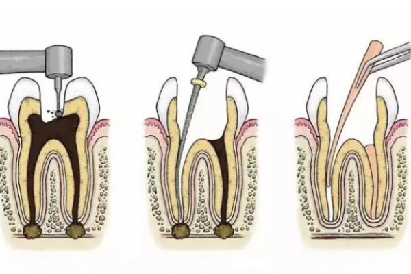 牙冠和嵌体哪个实用性强