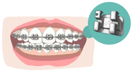 成人金屬托槽牙套價(jià)格m.cdi-phil.com