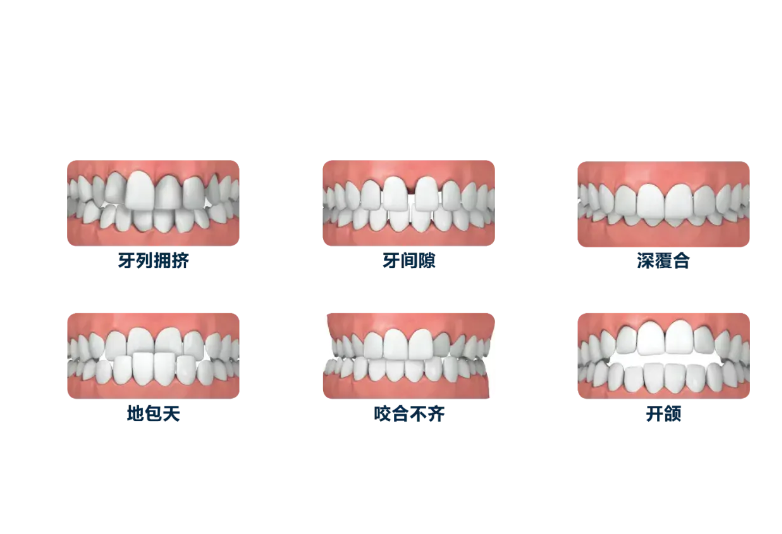 需要矯正的一些牙齒問(wèn)題