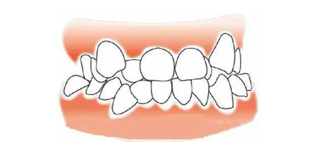 拔牙矫正并不适合所有人群