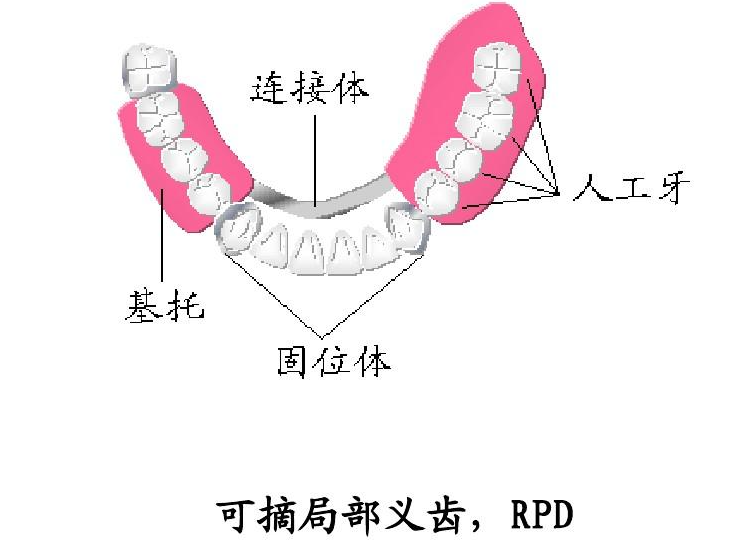 活動(dòng)義齒的種類(lèi)1、可摘局部義齒
