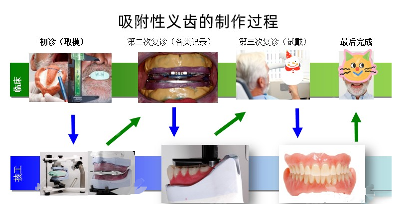 吸附式義齒帶著(zhù)舒服費用2萬(wàn)起