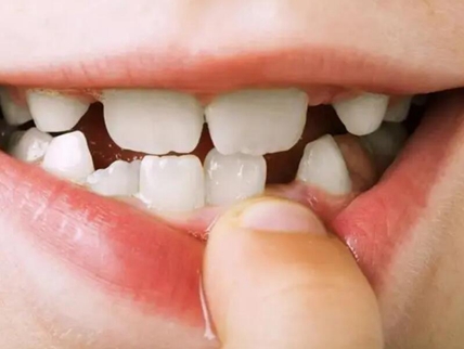 小孩子几岁开始换牙 牙好一生