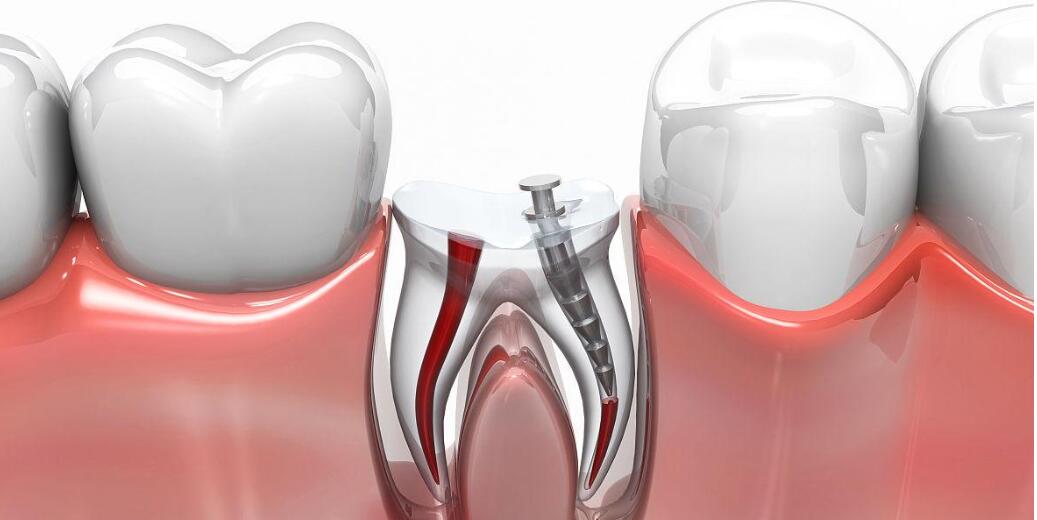根管治疗后补牙还是做牙冠-www.hszkq.cn