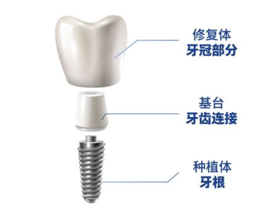 瑞士拓美種植體集采價格