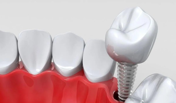 百康特种植牙是国产的不是进口的,四级纯钛材质属一线品牌