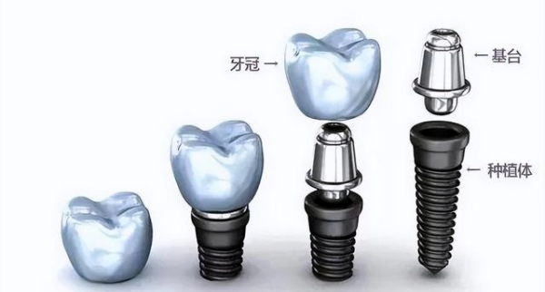 百康特种植牙是纯钛材料