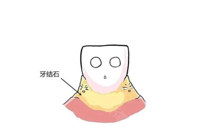 牙結石