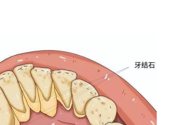 牙結石去除后牙縫變大怎么辦？
