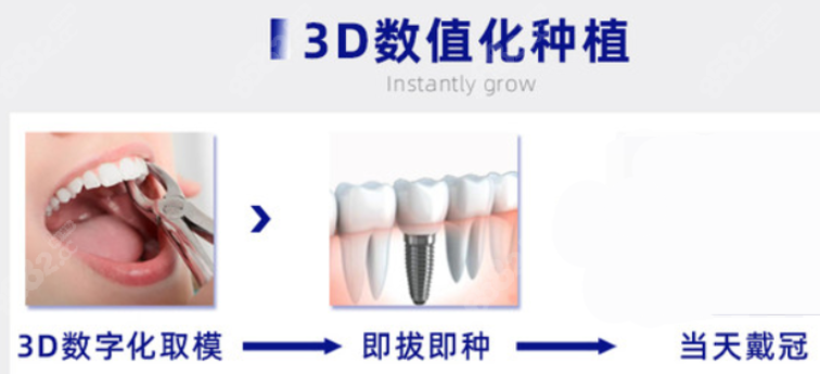 3d数字化种植牙