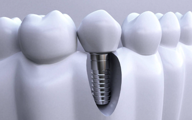 种植牙后牙龈溃烂的治疗方法参考