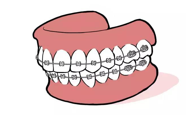钢丝牙套和隐形牙套的利与弊www.hszkq.cn