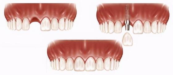 重庆牙博士口腔种植牙技术优势