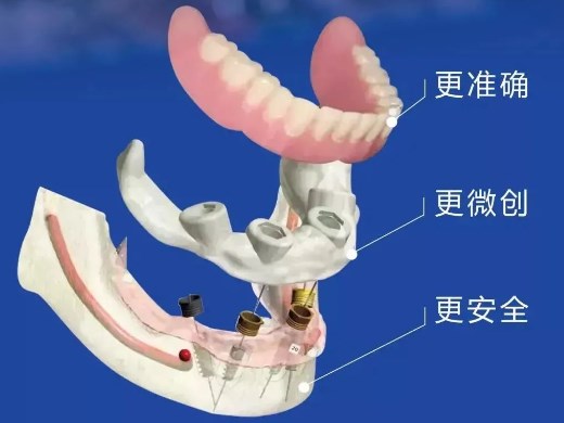 立得用種植手術(shù)