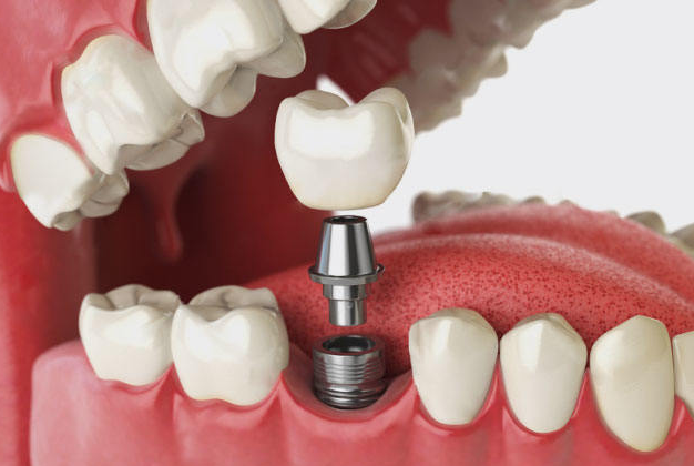 成都新橋口腔醫(yī)院種一顆牙多少錢？快速預(yù)約掛號get真實價格