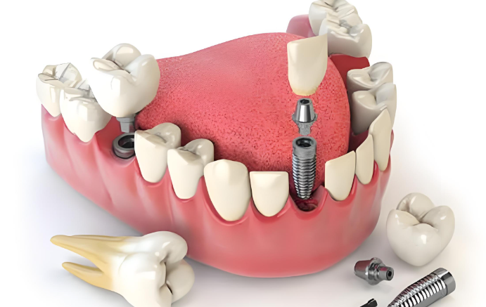 全口牙缺失修复用种植牙—稳固耐用,接近真牙体验