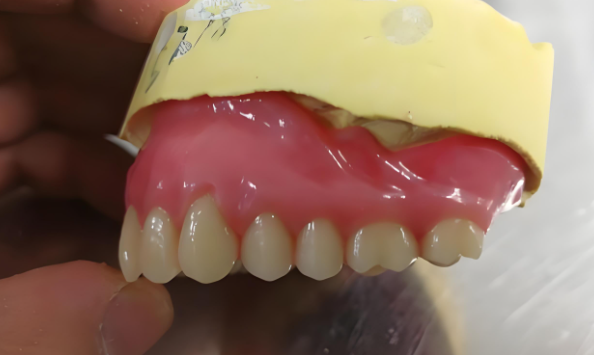 全口牙缺失修复用覆盖义齿—介于两者之间,兼顾功能与成本