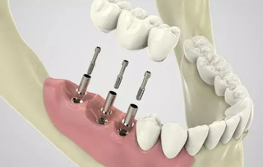 全口牙缺失修复用哪种方法好?如何选择