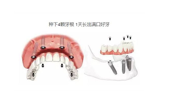 南京茀萊堡口腔種植牙多少錢(qián)