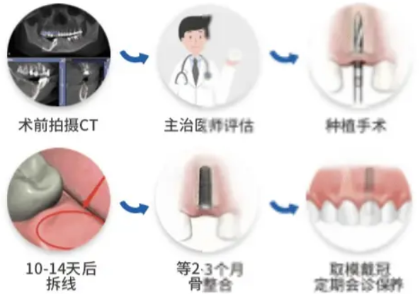 全口無牙頜種植流程步驟