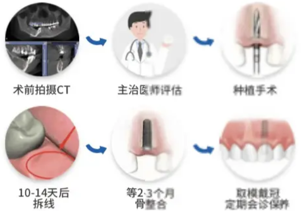 全口无牙颌种植流程步骤