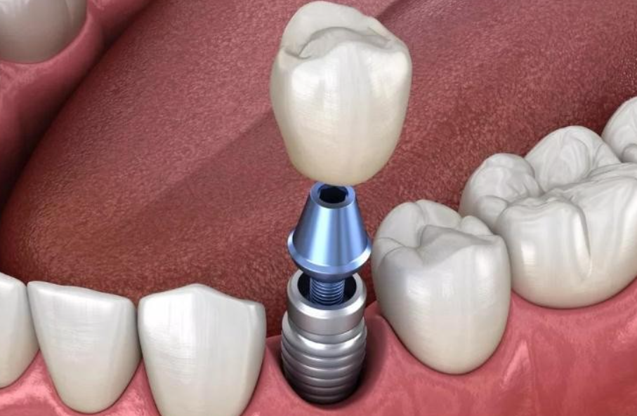 種植牙6年后的真實感受100字：揭秘種牙后遺癥的真相