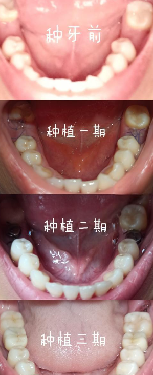 種植牙一期二期三期流程詳解www.hszkq.com