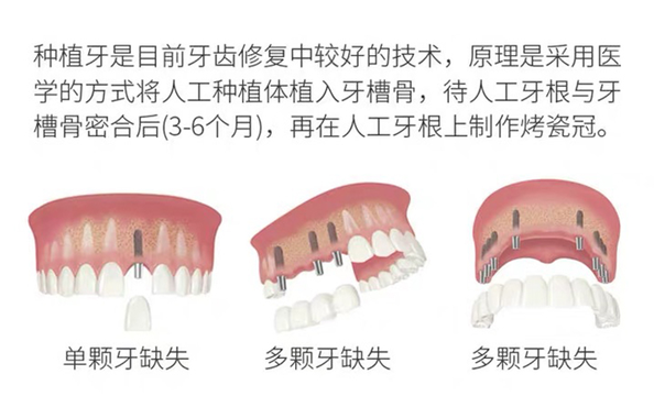 中诺口腔种植牙补贴政策www.hszkq.cn