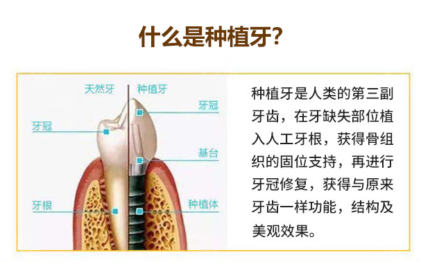 中诺口腔种植牙口碑怎么样？