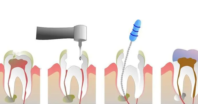 根管治疗全过程及步骤解析