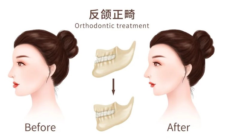 正頜手術(shù)