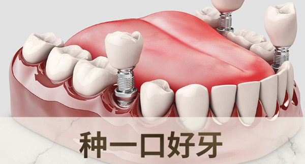 深圳美萊口腔種植牙價(jià)格表
