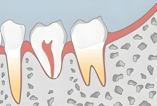 牙根吸收牙齿松动还有救吗？