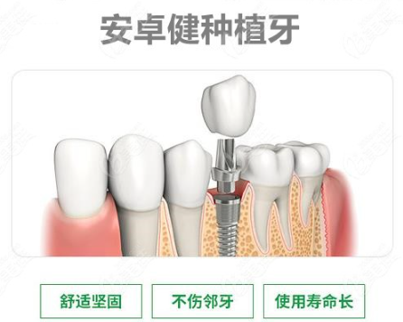 法國安卓健種植牙的優(yōu)勢