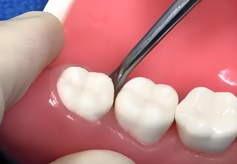 齲齒拔除價(jià)格表m.cdi-phil.com