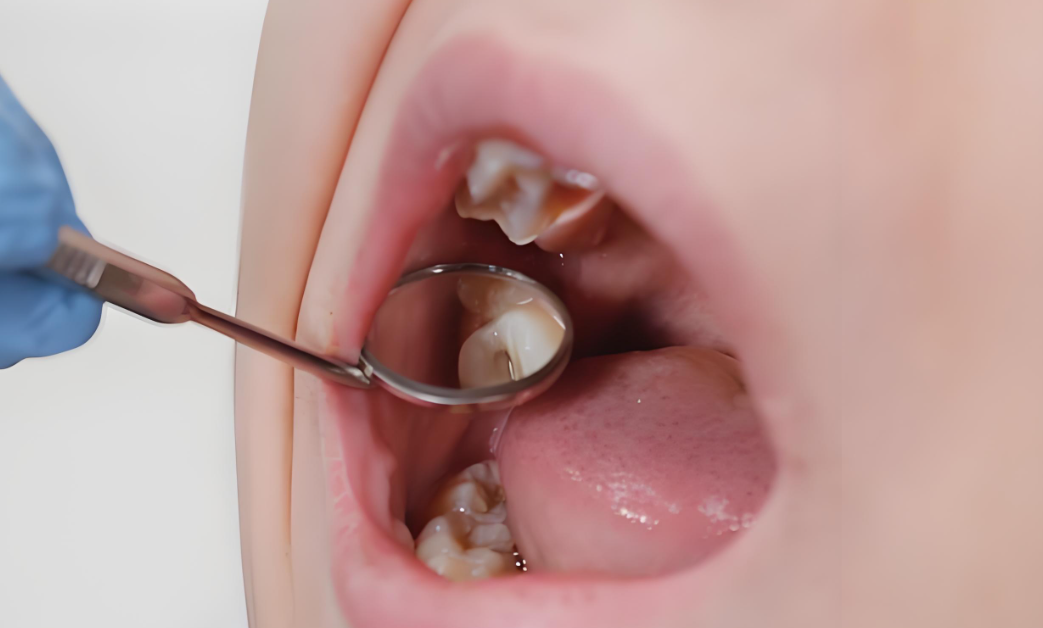 拔牙多少錢一顆牙價(jià)格表2024:正規(guī)醫(yī)院拔牙收費(fèi)標(biāo)準(zhǔn)(智齒500/后槽牙300/兒童乳牙200起)