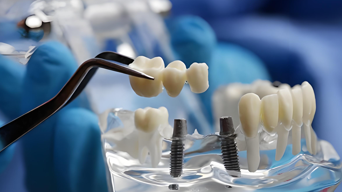 60歲以上免費(fèi)種牙在哪里申請(qǐng)?60歲以上無(wú)免費(fèi)種牙政策但有種植牙補(bǔ)貼政策