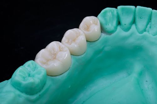 美國LAVA、德國VITA全瓷牙等對比m.cdi-phil.com