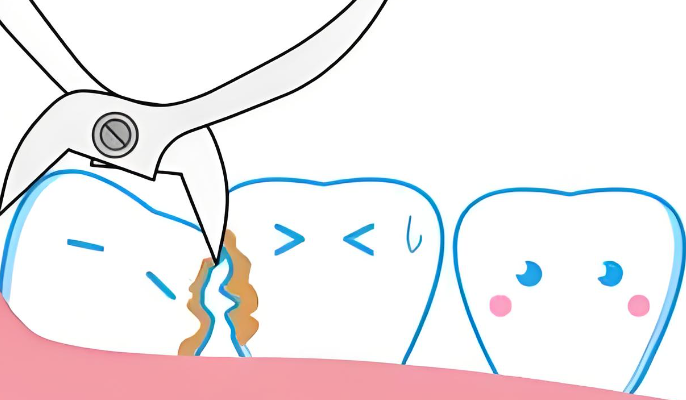 正畸拔牙4顆臉型會凹陷嗎？