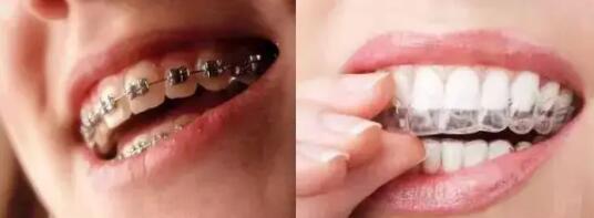 北京牙元素口腔矯正牙齒的價(jià)格