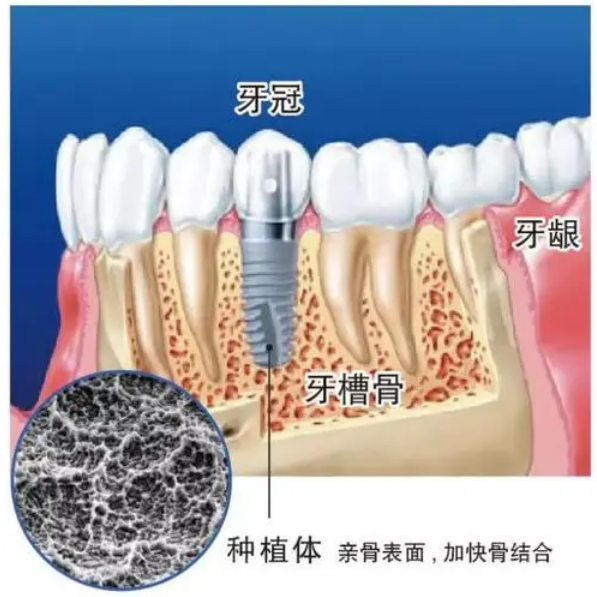 种植体取出后牙槽骨还能长起来么