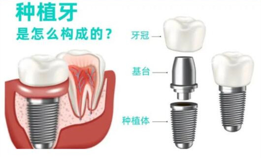武漢德韓口腔種植牙單顆價格表