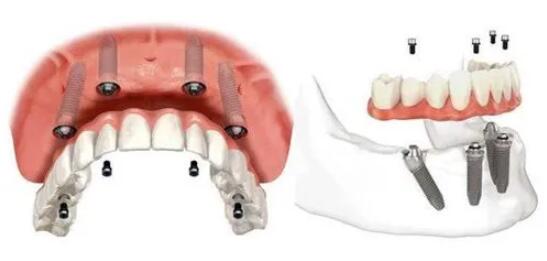 常德美奧口腔全口種植牙價(jià)格貴嗎？看價(jià)格表奧齒泰全口種植5萬(wàn)多就能做