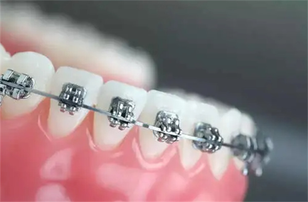 杭州隱形矯正牙套價(jià)格 杭州隱形矯正牙套價(jià)格