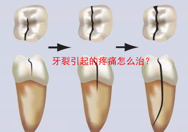 牙裂引起的疼痛怎么治