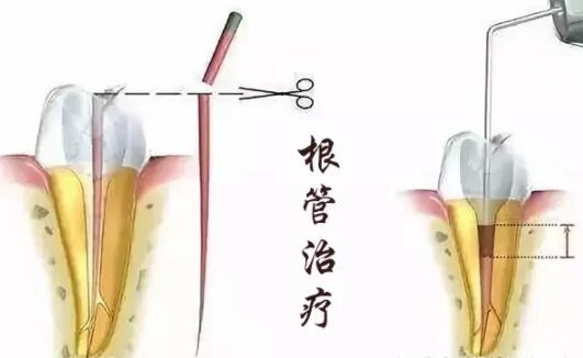牙裂了是拔了好還是做根管治療好