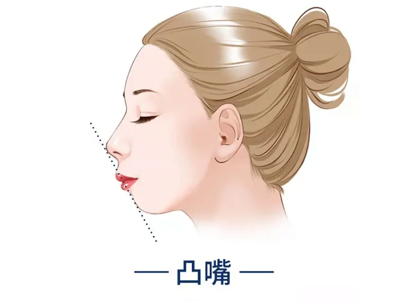 骨性凸嘴只能做手術(shù)了嗎