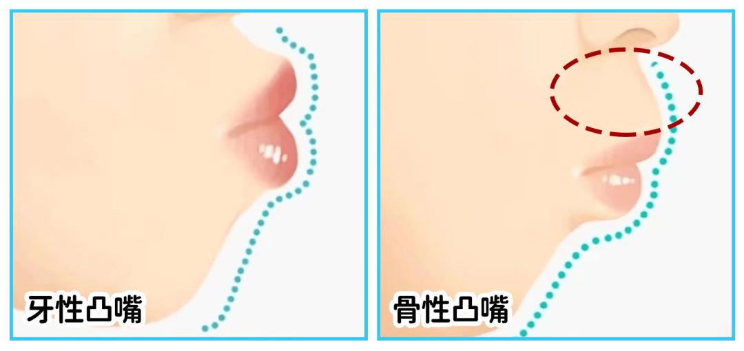 牙性凸嘴和骨性凸嘴對比