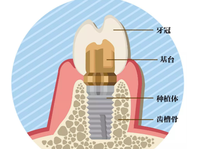 种植牙示意图